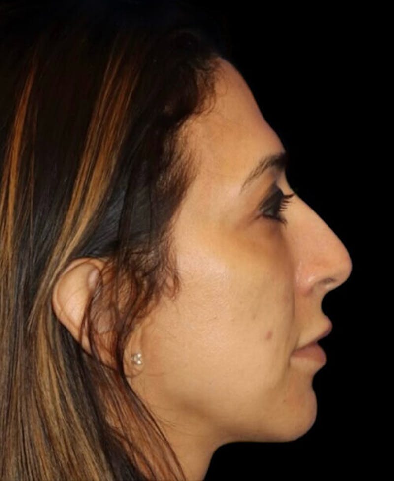 Profile Balancing Before & After Gallery - Patient 387558 - Image 5