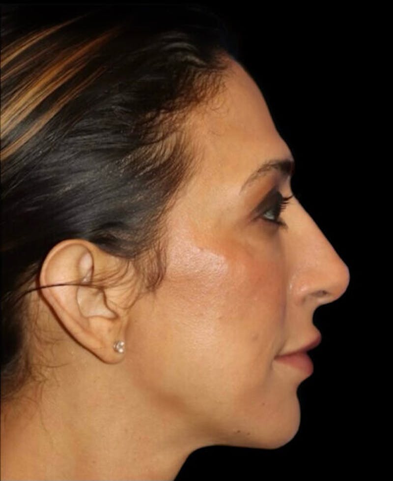 Profile Balancing Before & After Gallery - Patient 387558 - Image 6