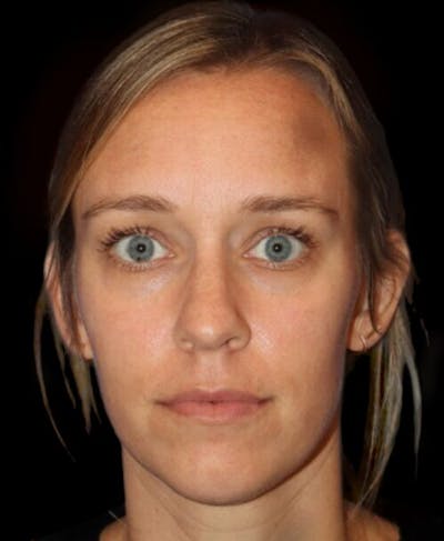 Tear Trough Augmentation Before & After Gallery - Patient 462397 - Image 1