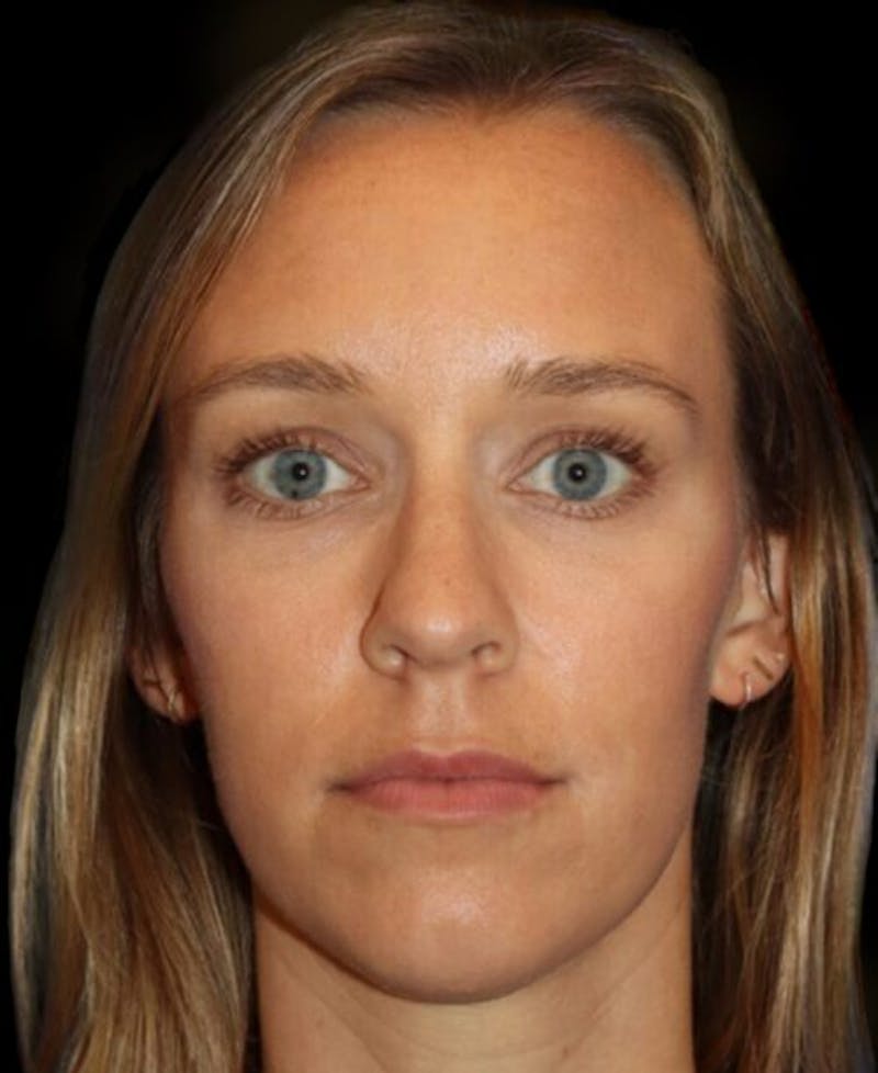 Tear Trough Augmentation Before & After Gallery - Patient 462397 - Image 2