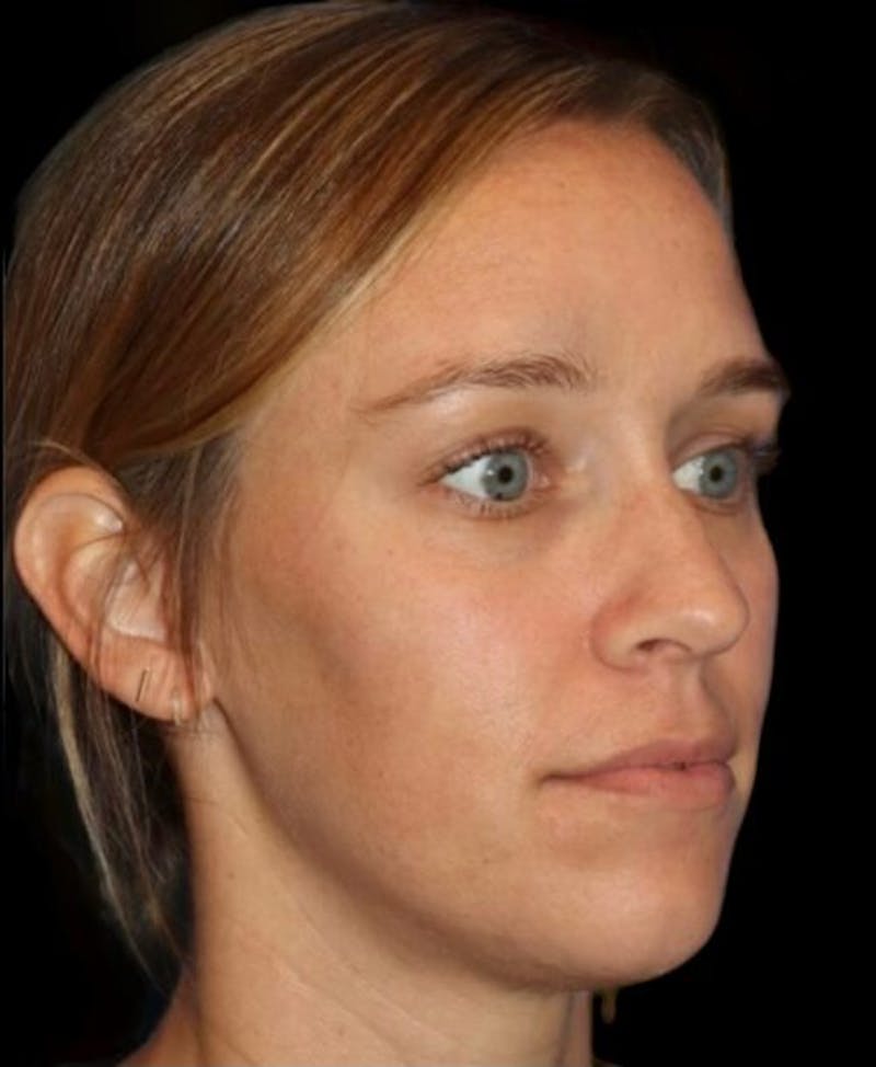 Tear Trough Augmentation Before & After Gallery - Patient 462397 - Image 3