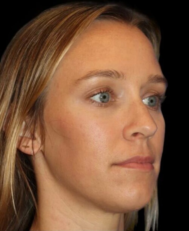 Tear Trough Augmentation Before & After Gallery - Patient 462397 - Image 4