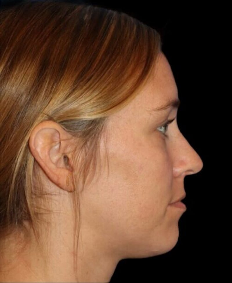 Tear Trough Augmentation Before & After Gallery - Patient 462397 - Image 5