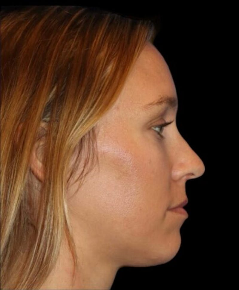 Tear Trough Augmentation Before & After Gallery - Patient 462397 - Image 6