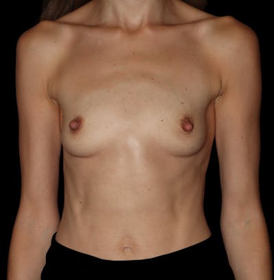 Preservé Breast Augmentation Before & After Gallery - Patient 317690 - Image 1