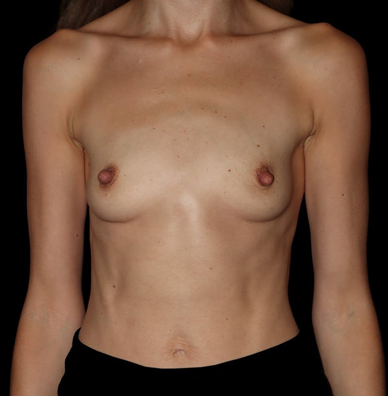 Preservé Breast Augmentation Before & After Gallery - Patient 317690 - Image 1