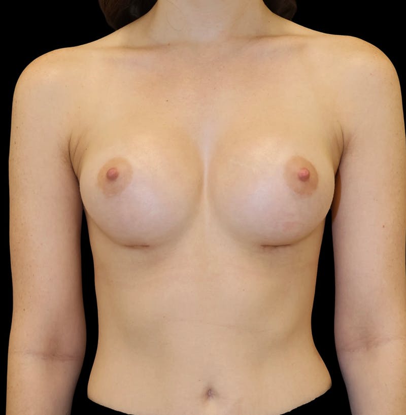 Breast Augmentation Before & After Gallery - Patient 210922 - Image 2