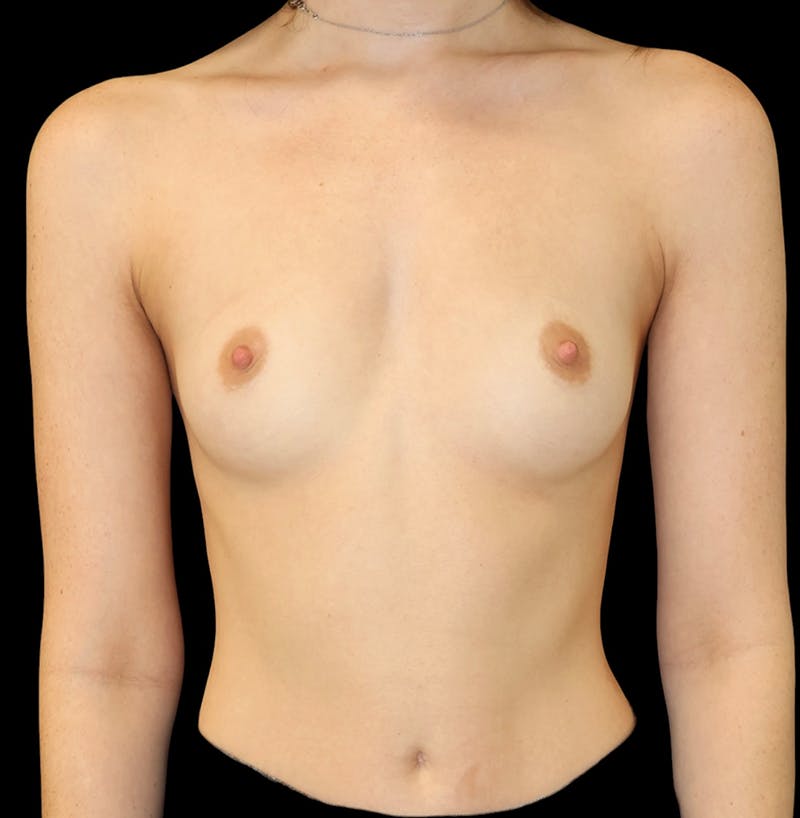 Breast Augmentation Before & After Gallery - Patient 210922 - Image 1