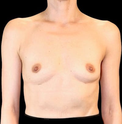 Preservé™ Breast Augmentation Before & After Gallery - Patient 145509 - Image 1