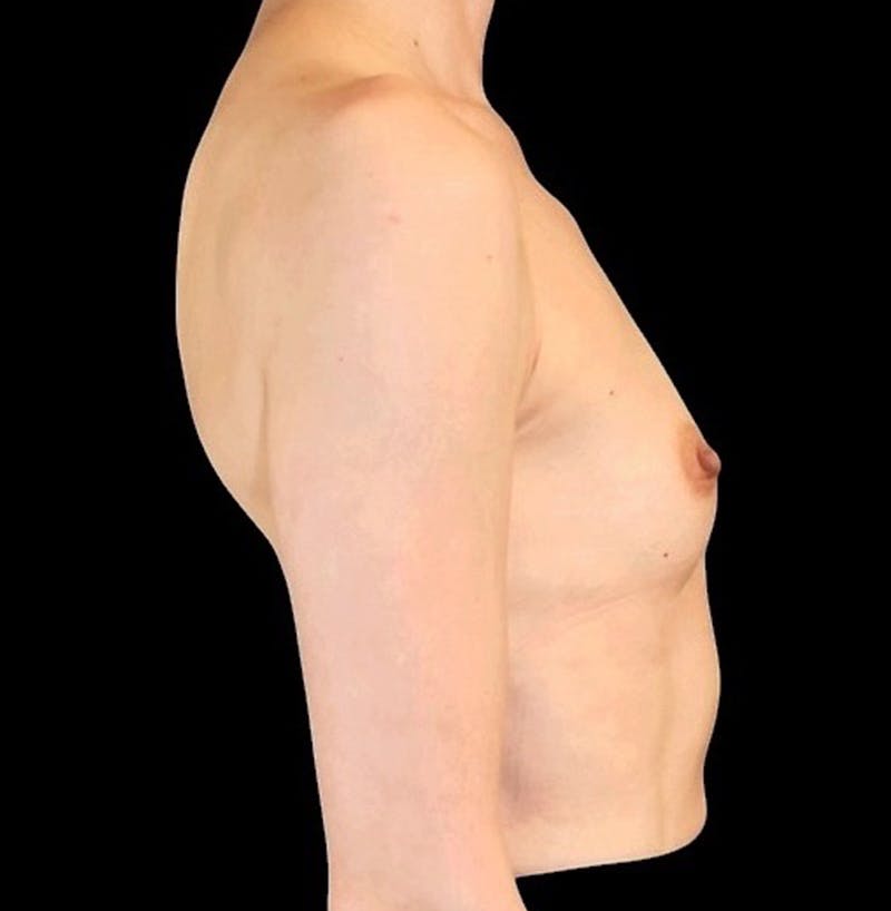 Preservé™ Breast Augmentation Before & After Gallery - Patient 145509 - Image 3