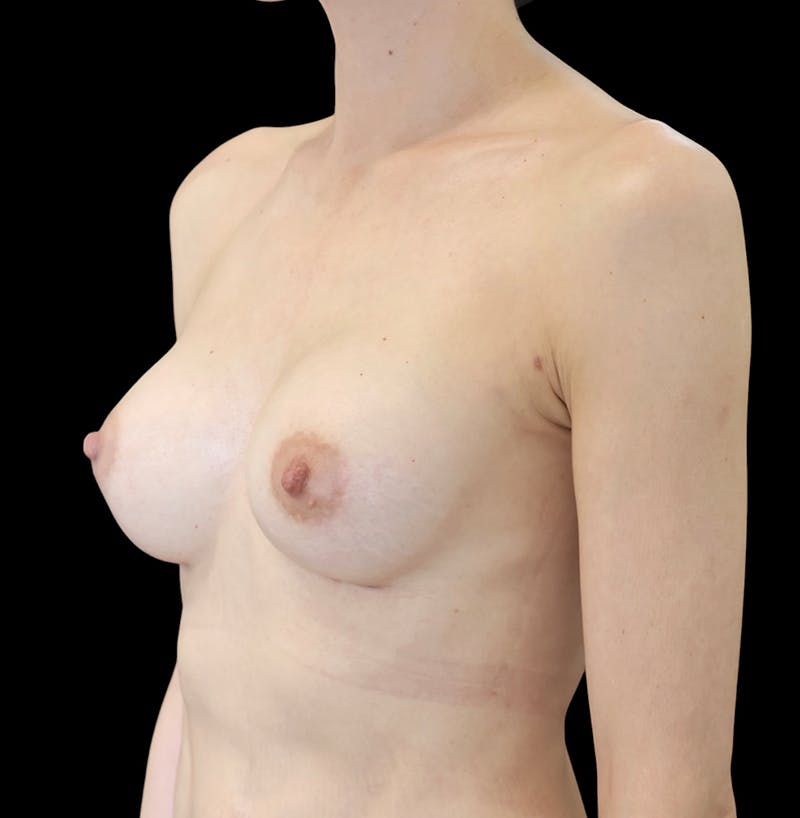 Preservé™ Breast Augmentation Before & After Gallery - Patient 145509 - Image 6