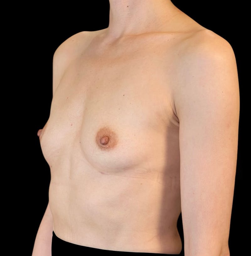 Preservé™ Breast Augmentation Before & After Gallery - Patient 145509 - Image 5