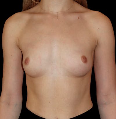 Breast Augmentation Before & After Gallery - Patient 126711 - Image 1