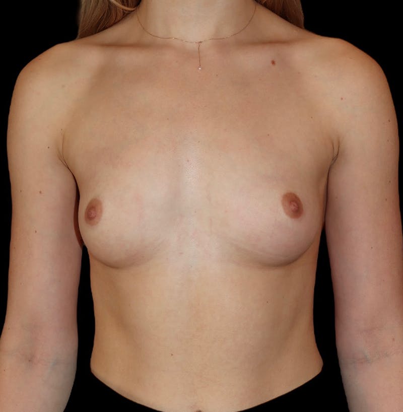 Breast Augmentation Before & After Gallery - Patient 126711 - Image 1