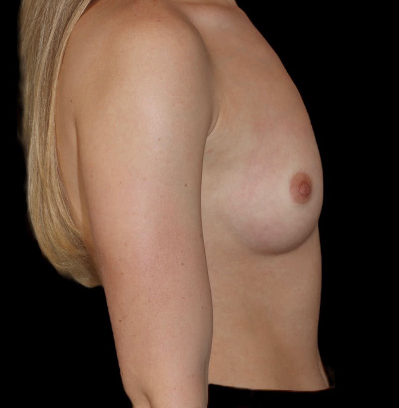 Breast Augmentation Before & After Gallery - Patient 126711 - Image 5