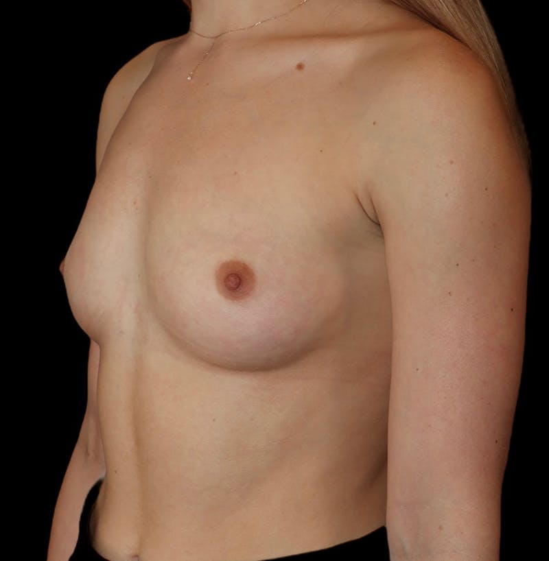 Breast Augmentation Before & After Gallery - Patient 126711 - Image 7