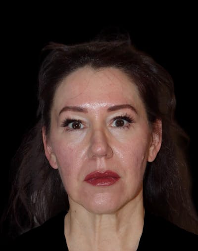 Facelift Before & After Gallery - Patient 334542 - Image 1