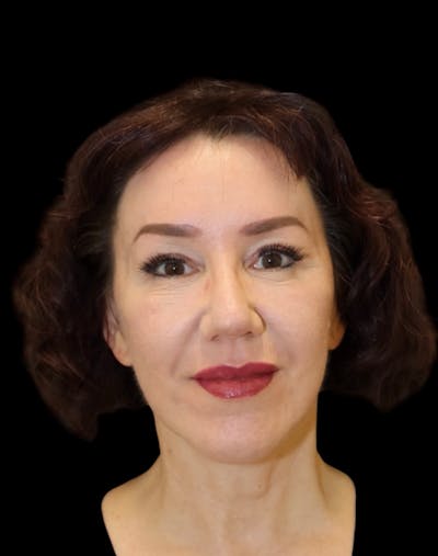Facelift Before & After Gallery - Patient 334542 - Image 2