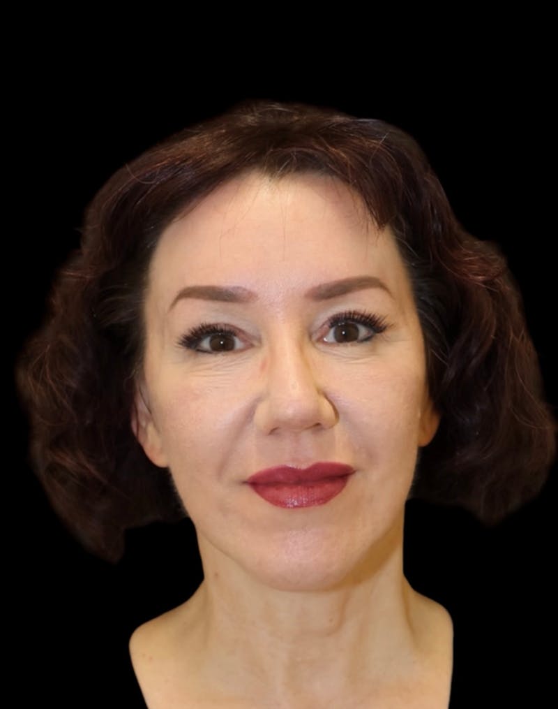 Facelift Before & After Gallery - Patient 334542 - Image 2