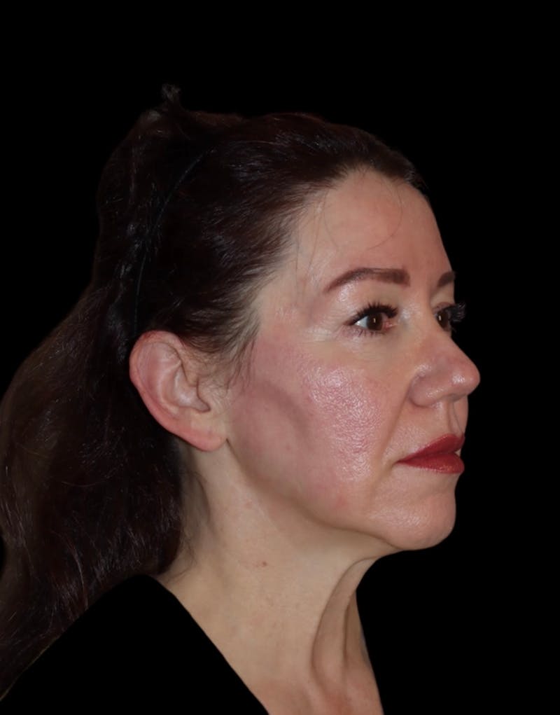 Facelift Before & After Gallery - Patient 334542 - Image 3