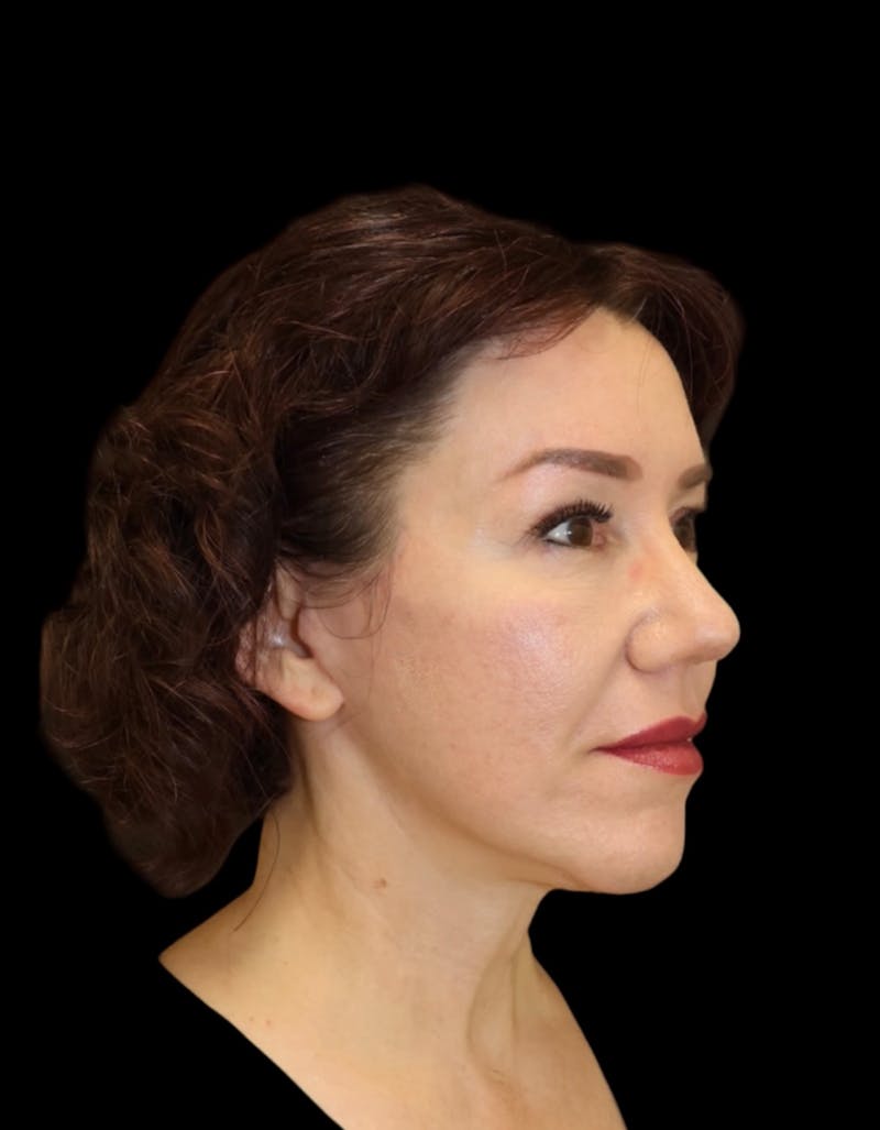 Facelift Before & After Gallery - Patient 334542 - Image 4
