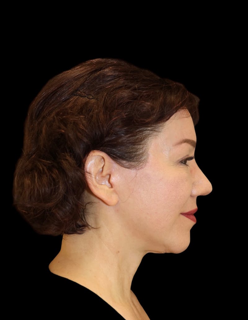 Facelift Before & After Gallery - Patient 334542 - Image 6