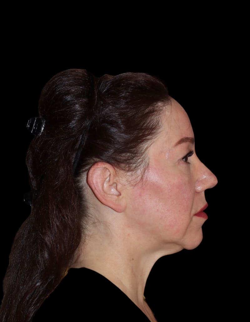 Facelift Before & After Gallery - Patient 334542 - Image 5