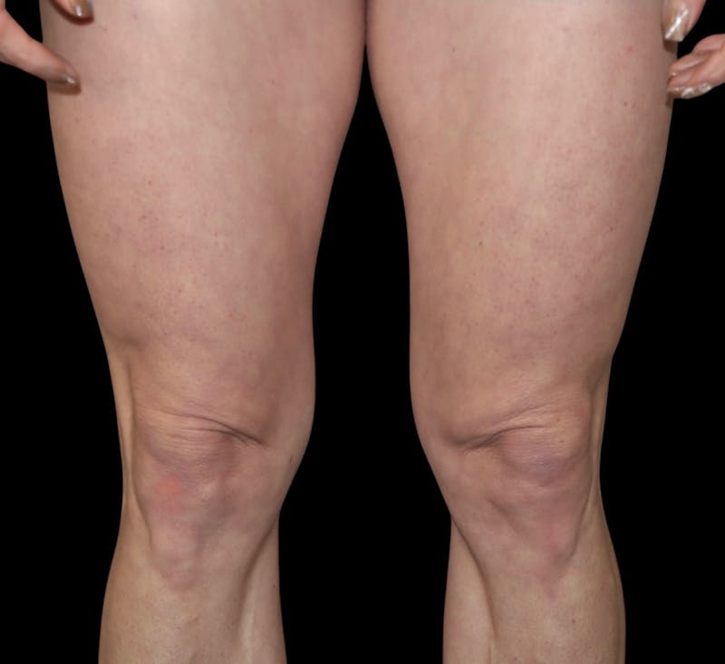 QuantumRF Before & After Gallery - Patient 114042 - Image 1