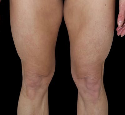 QuantumRF Before & After Gallery - Patient 114042 - Image 2