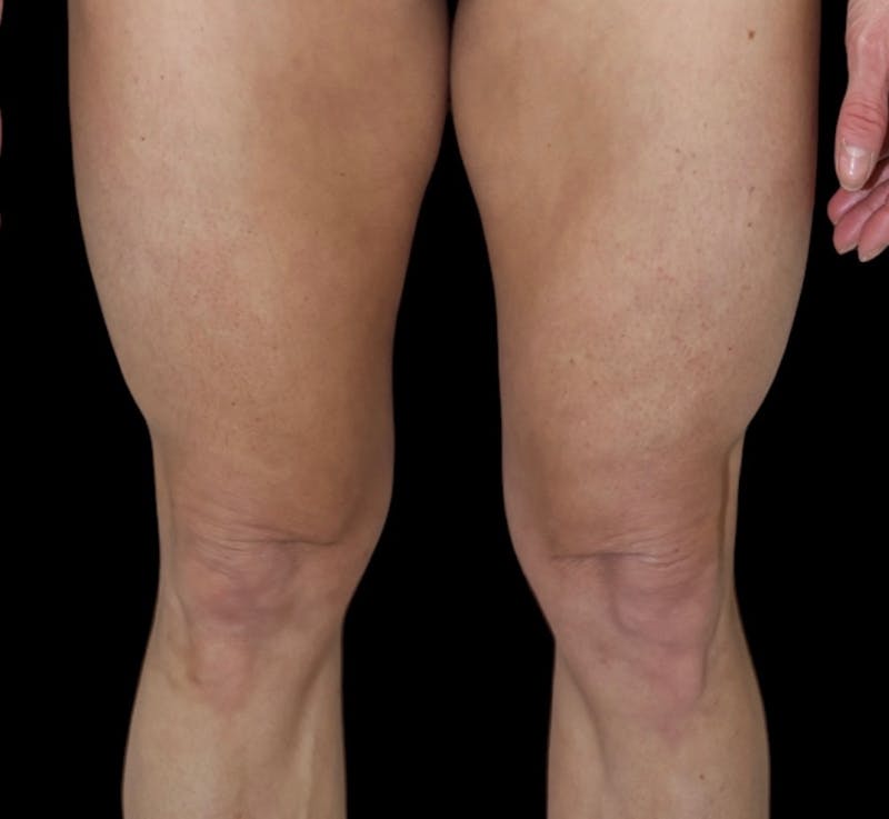 QuantumRF Before & After Gallery - Patient 114042 - Image 2