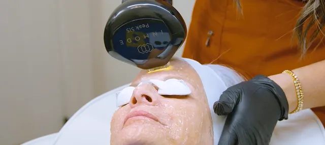 Lumecca Peak IPL photofacial treatment for pigmentation and redness