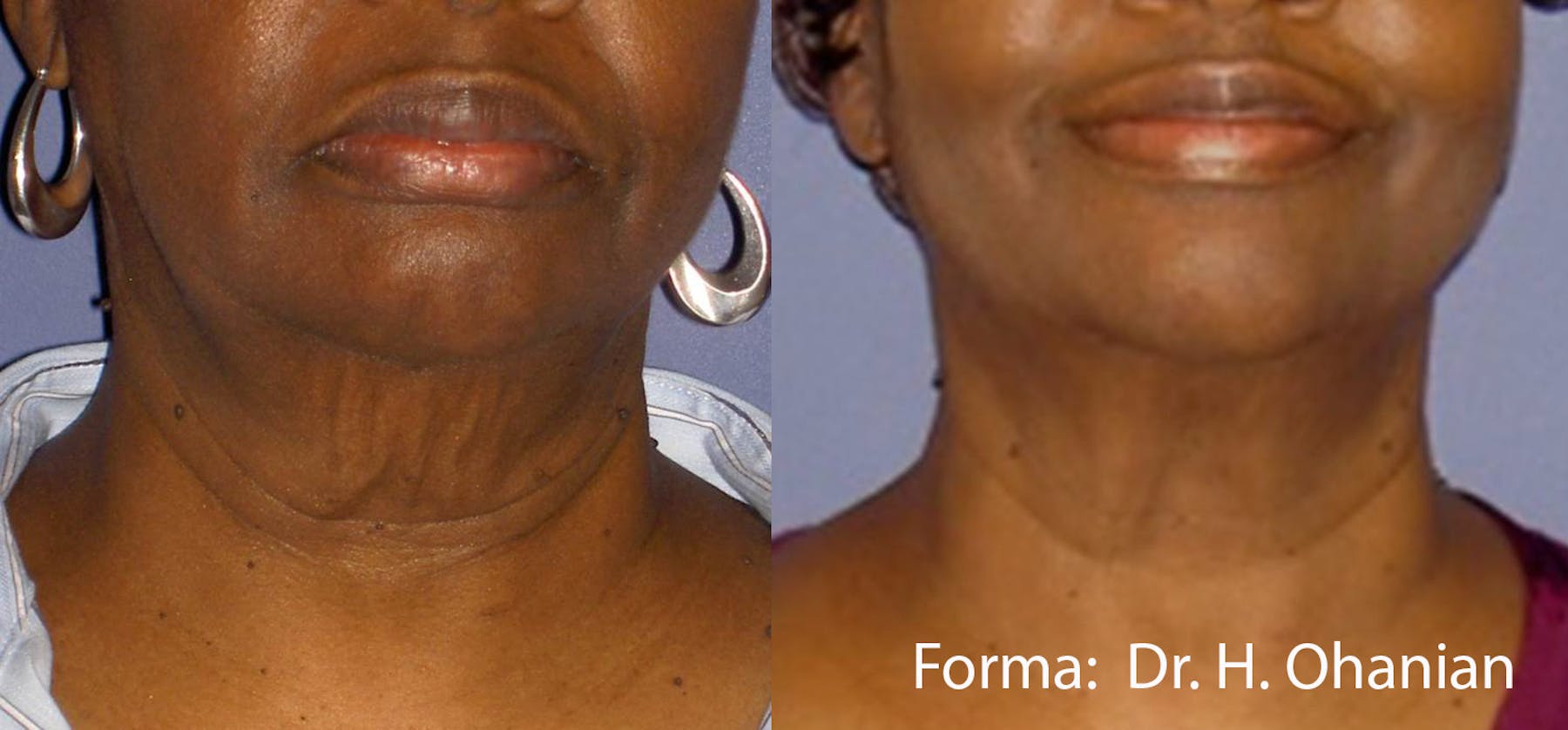 Forma Before and After