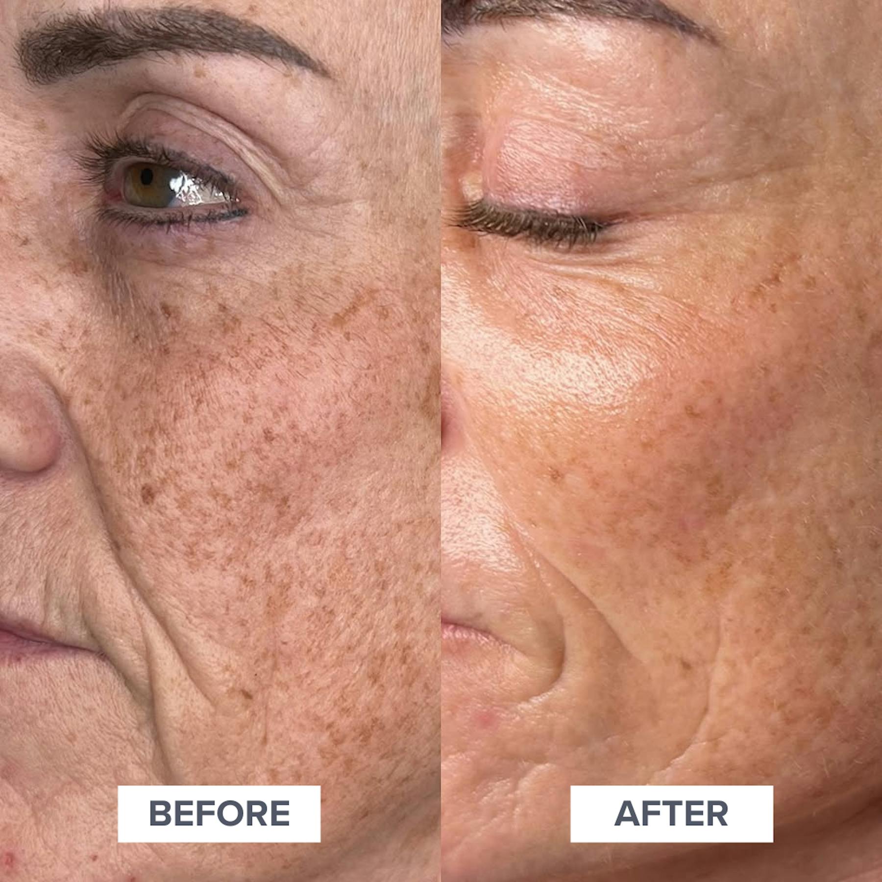 AlumierMD Before and After