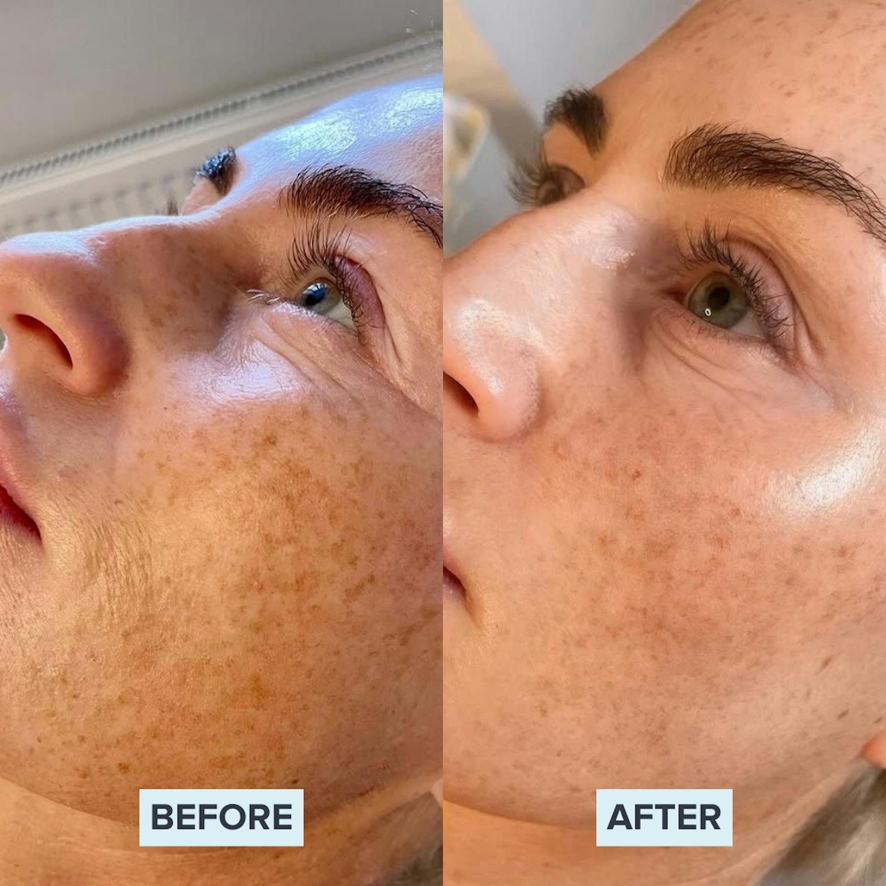 AlumierMD Before and After