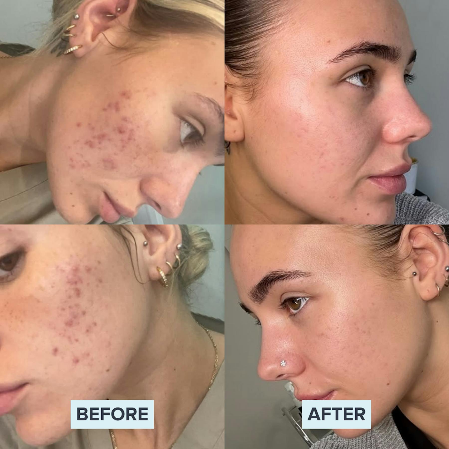 AlumierMD Before and After