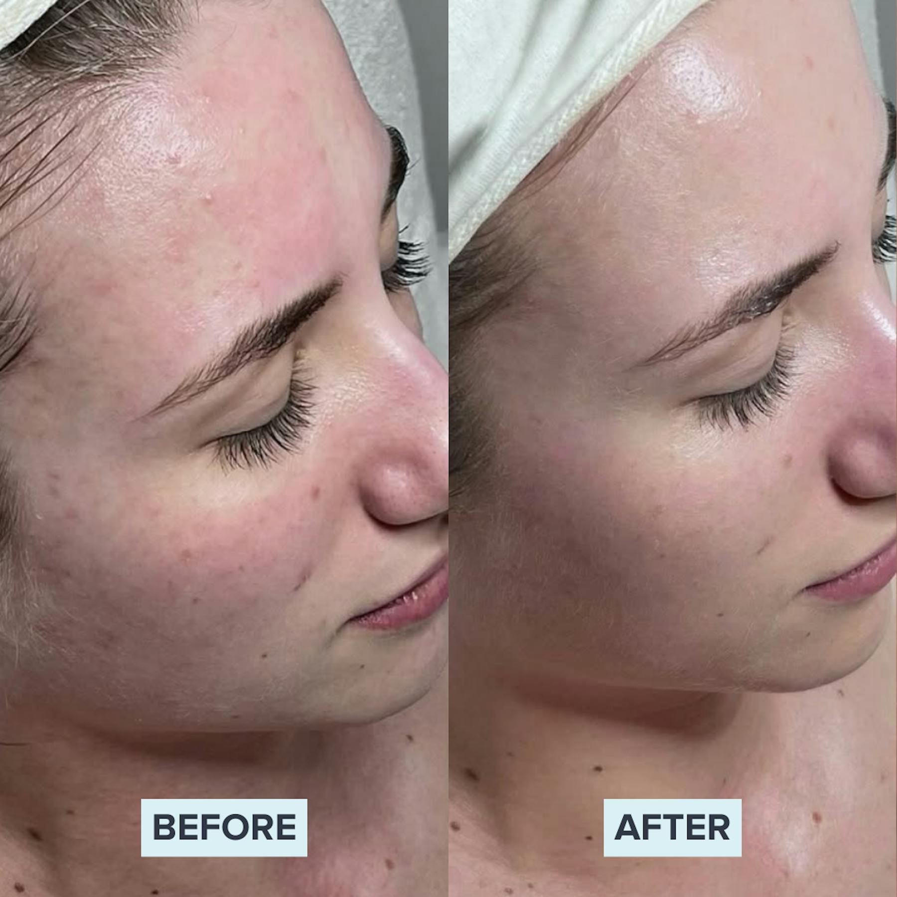 AlumierMD Before and After