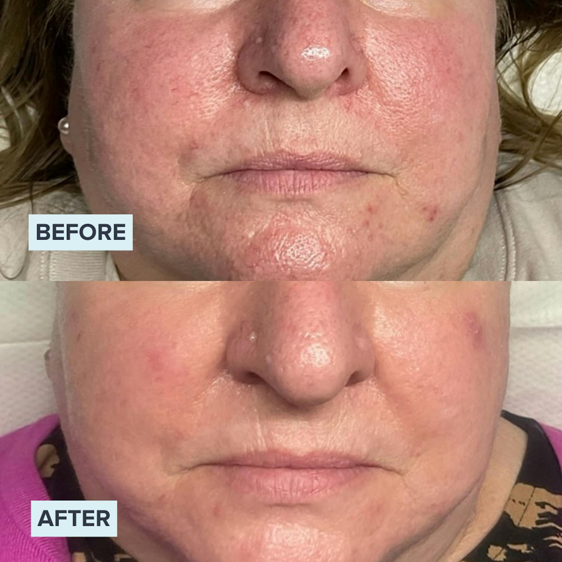AlumierMD Before and After