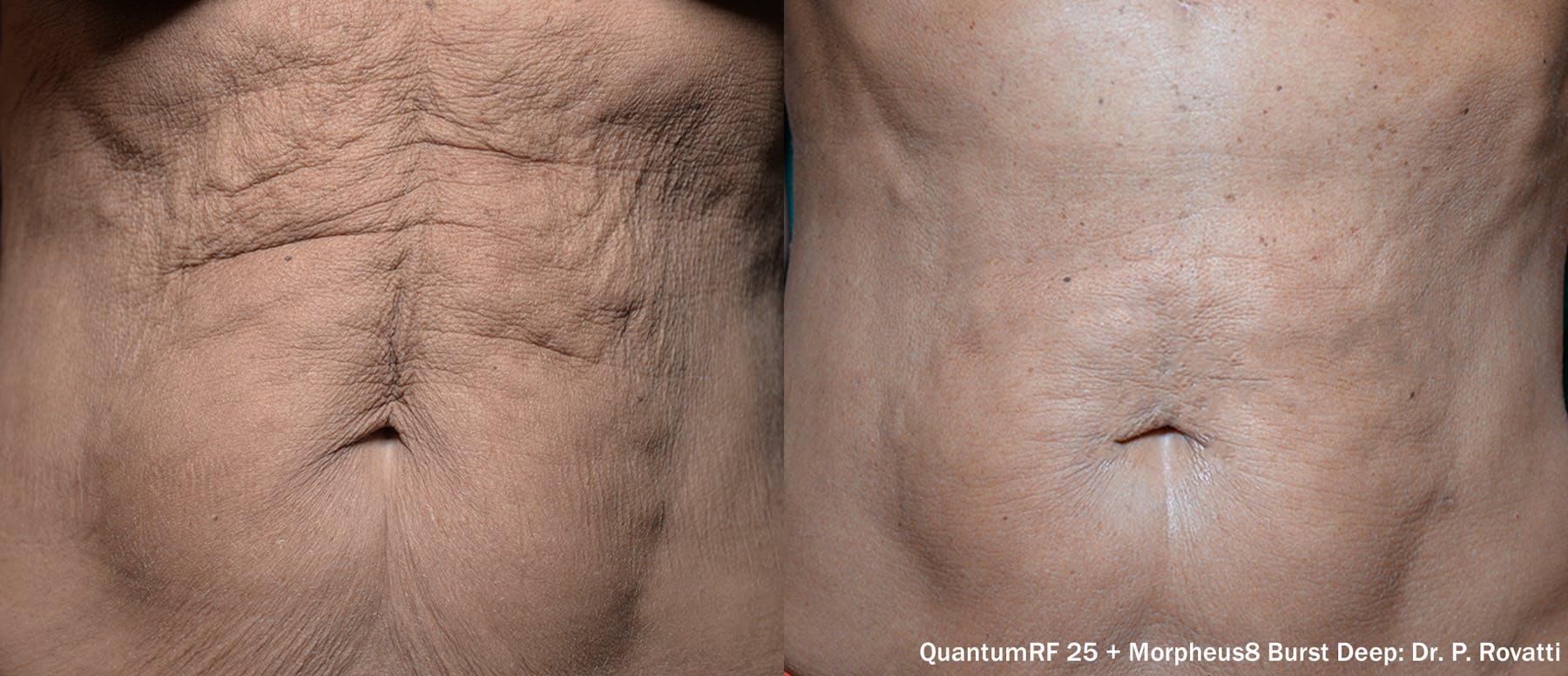 QuantumRF Before and After