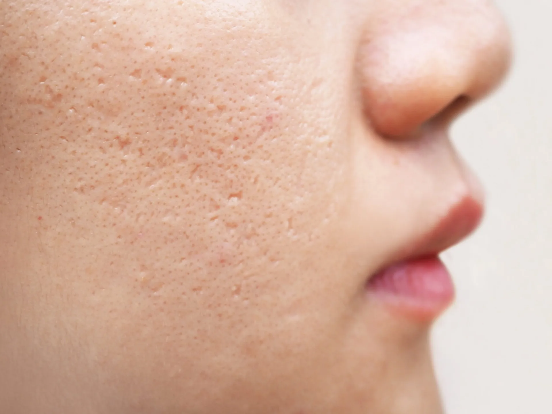 Microneedling treatment used as part of an individualized acne scar treatment plan
