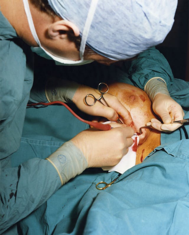 Fear of mastectomy is something that runs through the adult life of most women today. It has long been one of my biggest fears. Most women, including myself have had more than one scare. The Apple of my Eye, 1991.