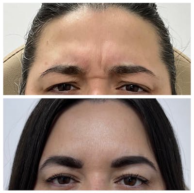 Medspa Services Before & After Gallery - Patient 140869 - Image 1