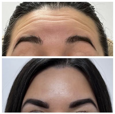 Medspa Services Before & After Gallery - Patient 283399 - Image 1