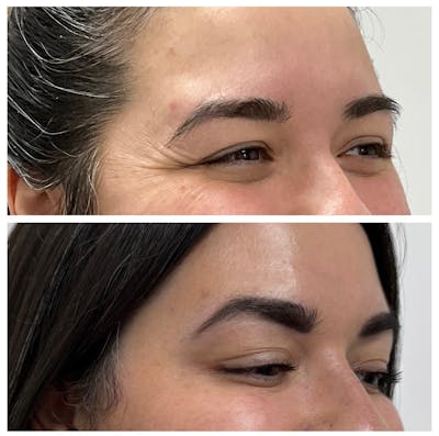 Medspa Services Before & After Gallery - Patient 123293 - Image 1