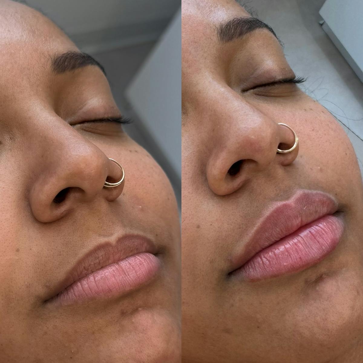 Medspa Services Before & After Gallery - Patient 272563 - Image 1
