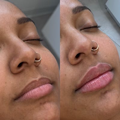 Medspa Services Before & After Gallery - Patient 272563 - Image 1