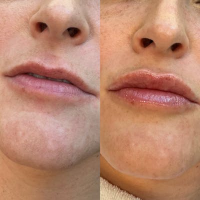 Medspa Services Before & After Gallery - Patient 243645 - Image 1