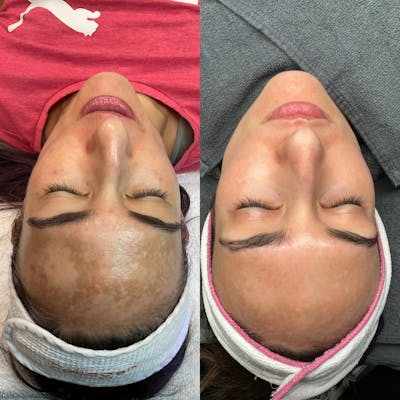 Medspa Services Before & After Gallery - Patient 289767 - Image 1
