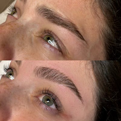 Medspa Services Before & After Gallery - Patient 229862 - Image 1