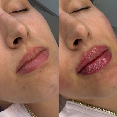 Medspa Services Before & After Gallery - Patient 296223 - Image 1