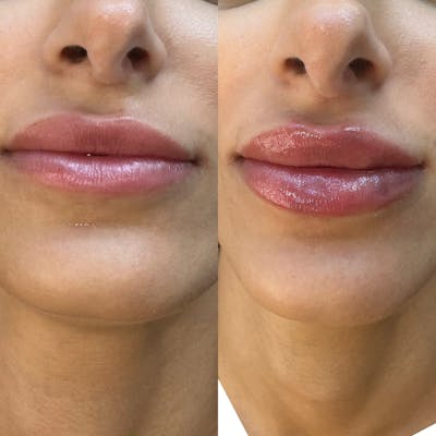 Medspa Services Before & After Gallery - Patient 211885 - Image 1